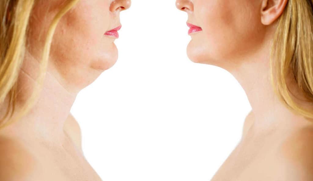 Double Chin treatment Balsall before and after results
