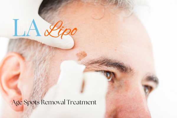What Are the Most Effective Treatments for Age Spots Balsall?
