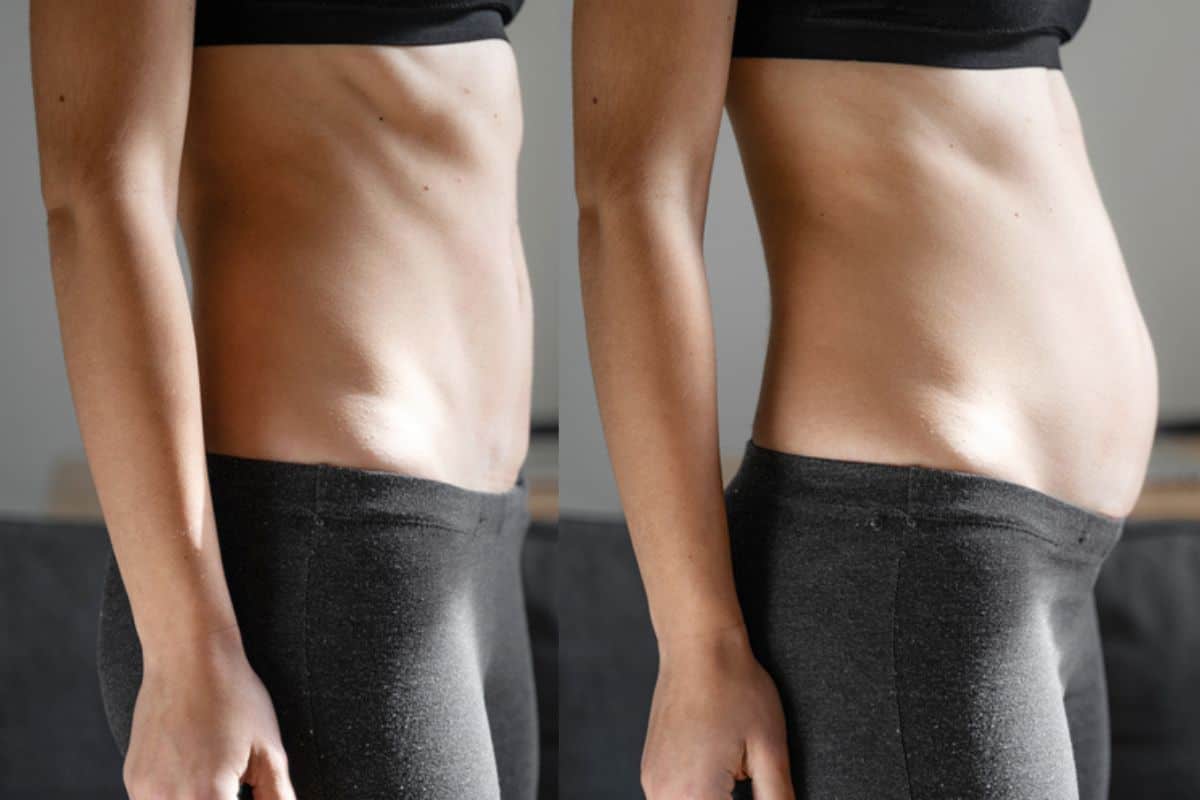 How long does diastasis recti take to improve Balsall?