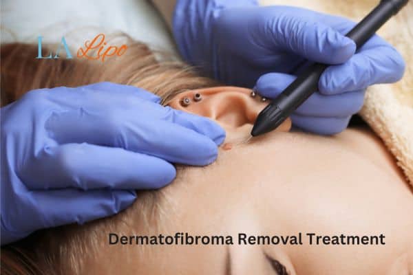 Dermatofibroma Removal Treatment Balsall