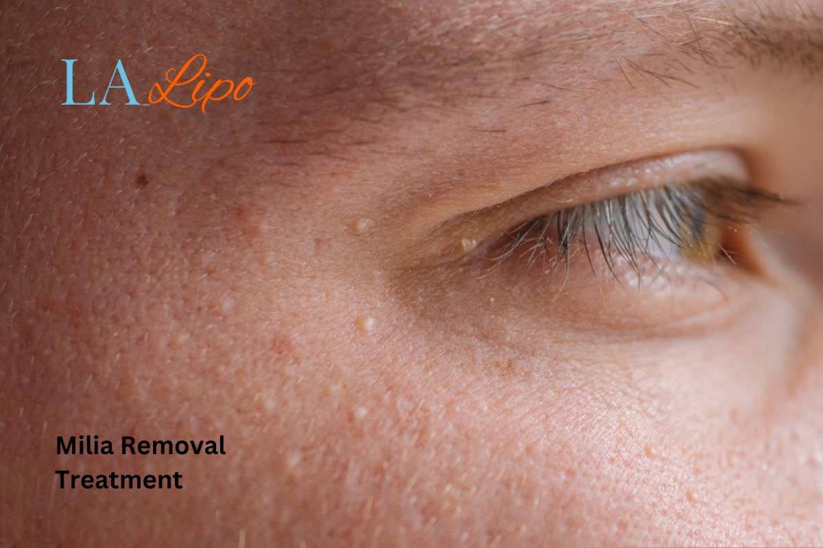 Cryopen Milia Removal: Is It the Easiest and Safest Option Balsall?