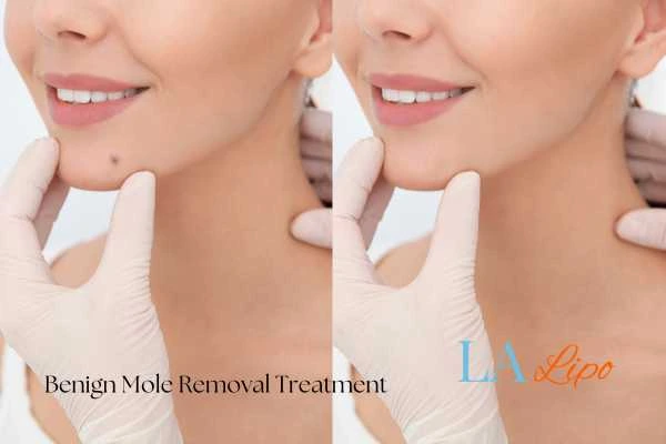 Before-and-after results following benign mole-removal treatment Balsall