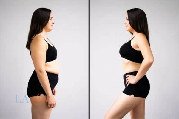 image of woman before and after results of LA-EMS Body Sculpting Balsall to help treat Diastasis recti