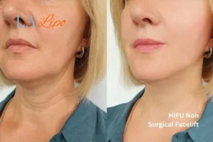 hi-fu for wrinkles Balsall before and after results