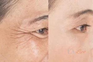 Before and after results of woman - HI-fu wrinkles reduction treatment Balsall