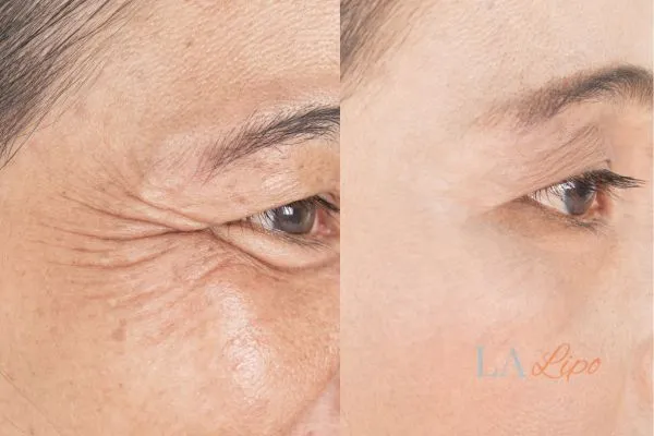 Before and after results of woman - HI-fu wrinkles reduction treatment Balsall
