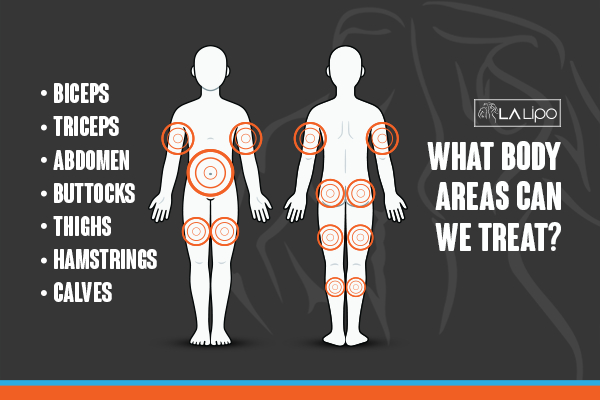 Graphic to show areas you can have LA-EMS Body Sculpting Balsall treatment.