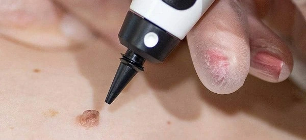 skin tag removal using cryopen Balsall