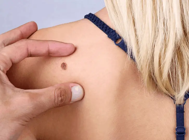 woman having mole removal Balsall consultation before treatment.
