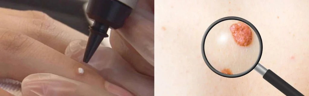 CryoPen practitioner Balsall assessing a benign mole before treatment