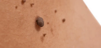 image of a skin tag Balsall