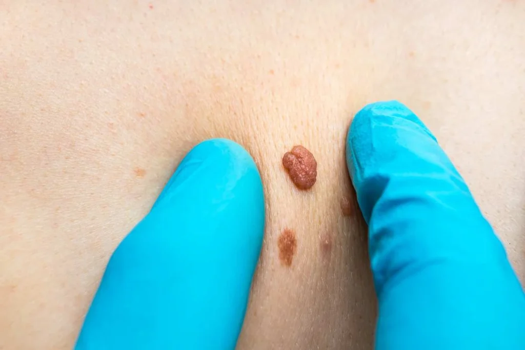 Consultant examining a skin tag Balsall