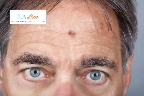 Solar Lentigo Removal Balsall image of man with mark on his forehead