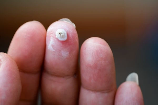 wart on person finger - cryotherapy to treat from LA LIPO Balsall
