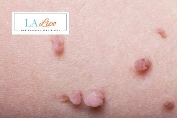 Does cryopen skin tag removal Balsall hurt? Find out now call our team today!