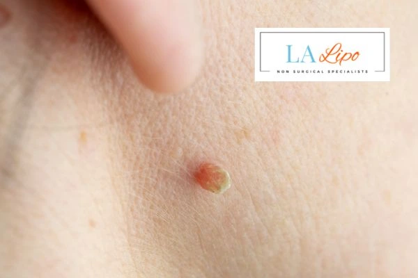 Book skin tag removal Balsall today speak to our team now!