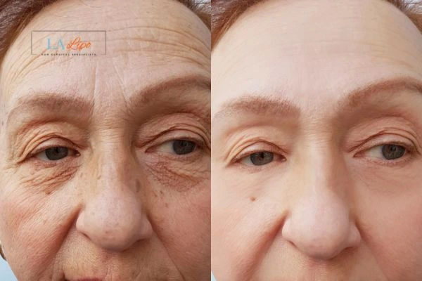 The powerful benefits of Morpheus8 Treatment Balsall - Call Our team today!