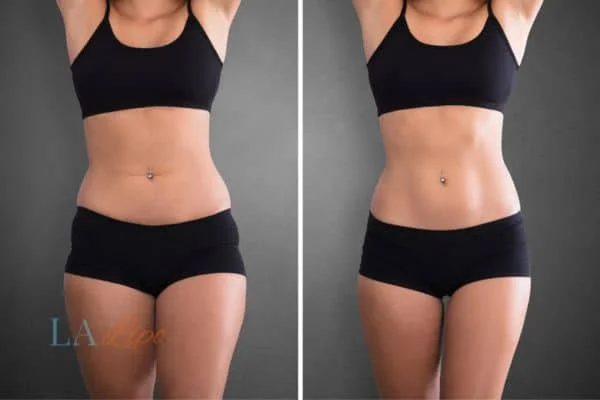 before and after results of non-surgical treatment to help a woman's body image and mental health Balsall