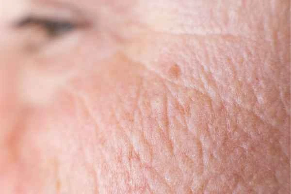 close up picture of a woman's face showing an age spot Balsall