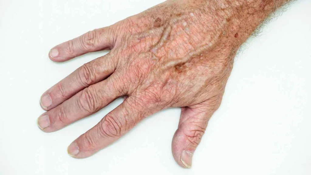 Male hand showing age spot Balsall