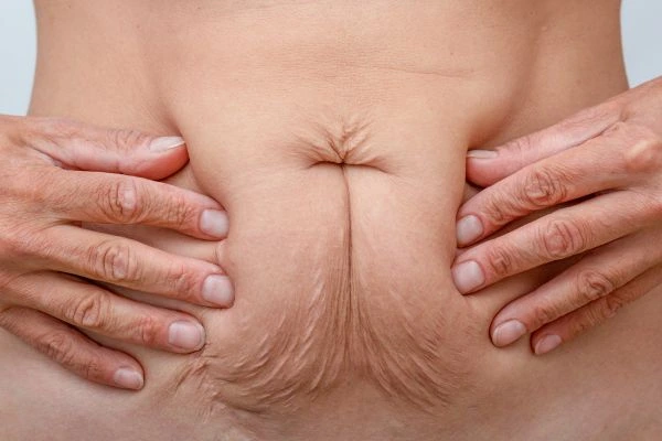 Should I Combine Diastasis Recti Treatment with Body Contouring for Better Results Balsall?