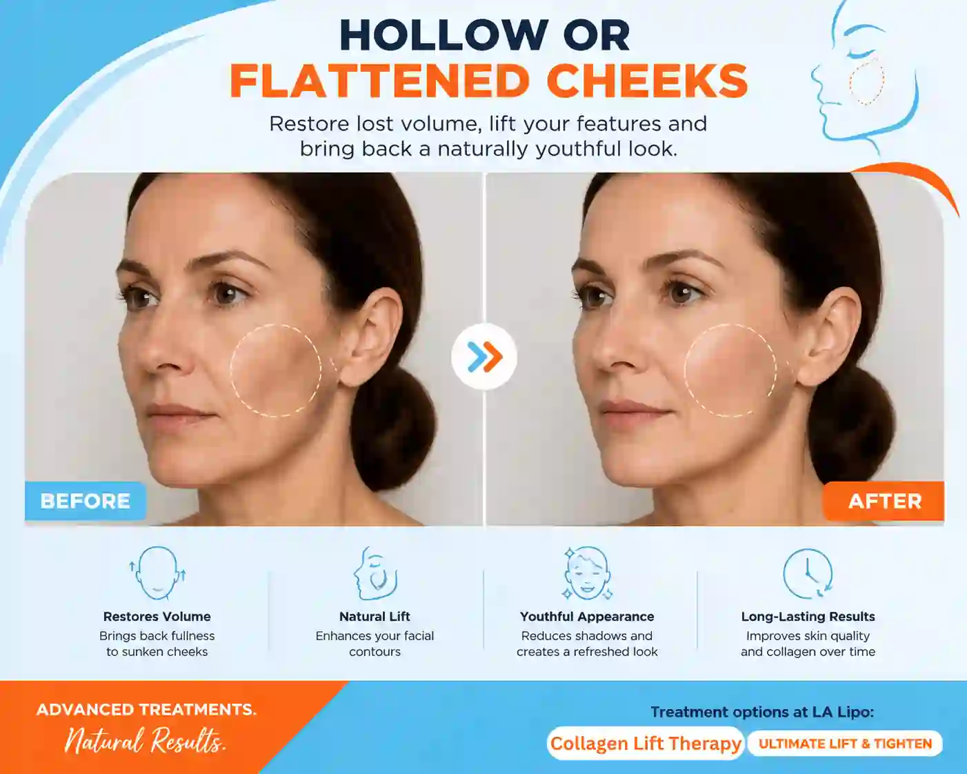 Sign #4: Hollow or Flattened Cheeks Balsall