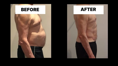What Symptoms Can Diastasis Recti Cause in Men? Weak Core, Back Pain and Poor Posture Balsall